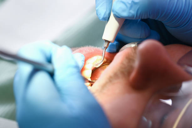 Best Emergency Root Canal Treatment in Ly Lake, IL